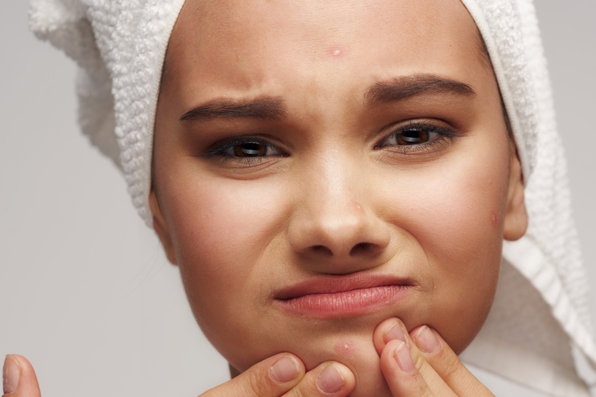 Η σοκολάτα προκαλεί πραγματικά ακμή; Ποιος ο μύθος και ποια η αλήθεια