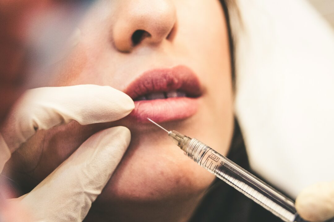 Lip fillers: Ο κίνδυνος του υαλουρονικού στα χείλη για την υγεία